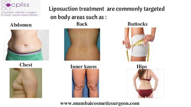 lipo breast reduction Lipo breast reduction